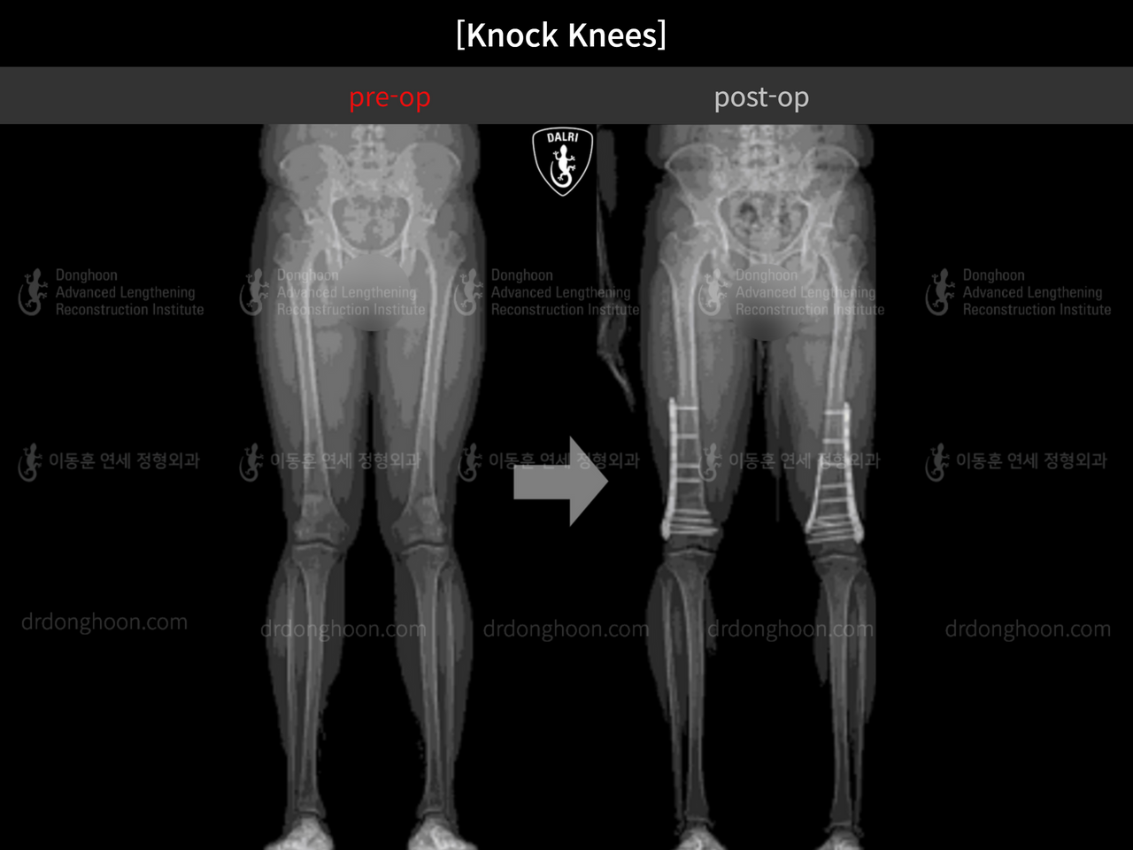 Before and after adult knock knees, case 13002083, image 2, Dr. Donghoon institute (DALRI)