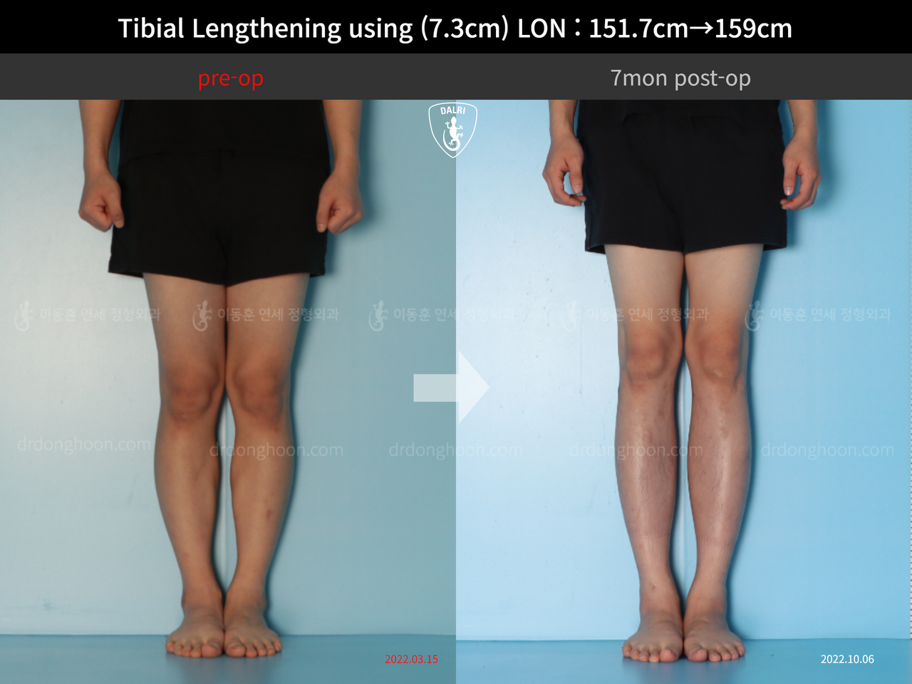 Before and after cll lon, case 13119336, image 5, Dr. Donghoon institute (DALRI)