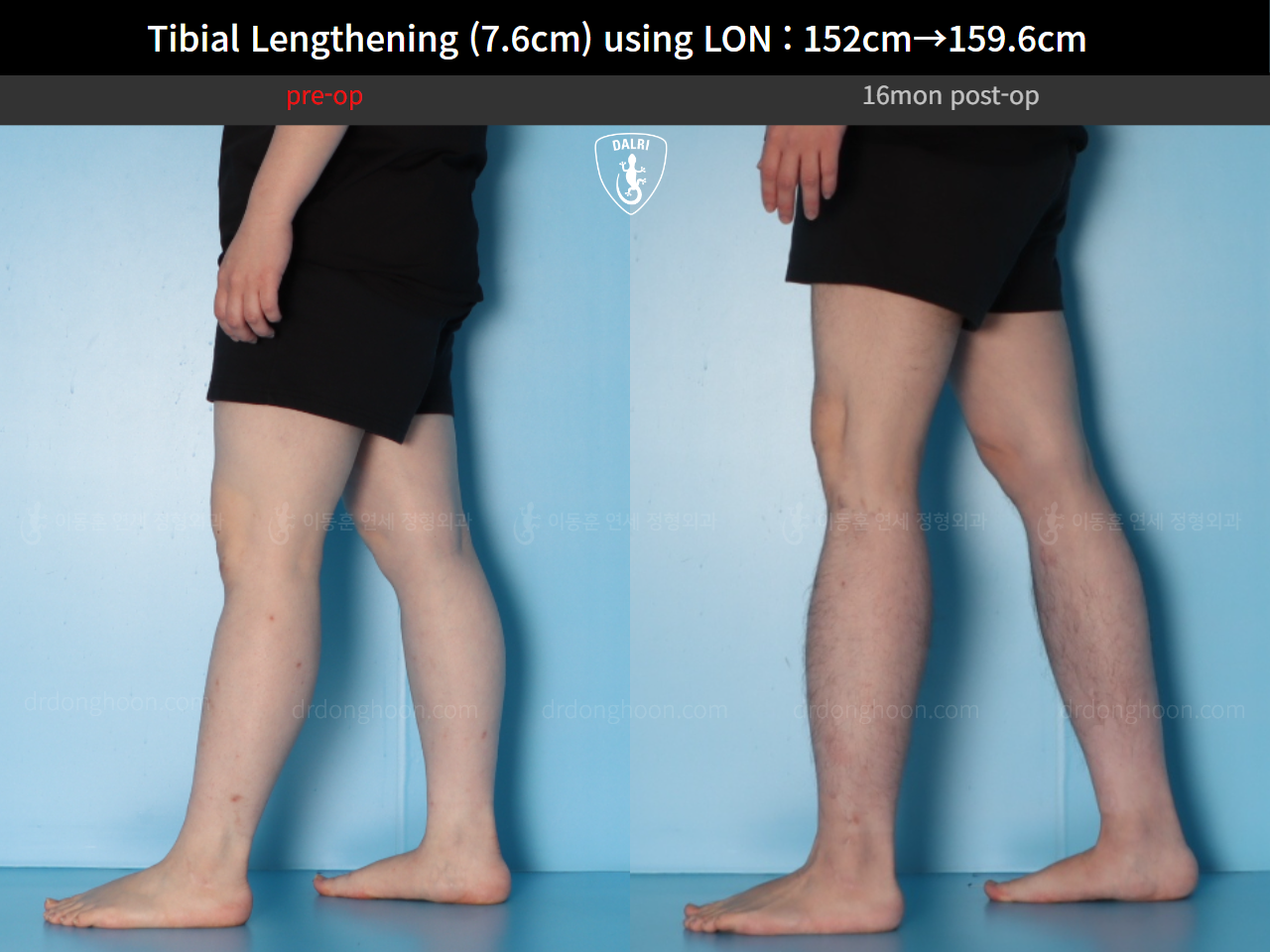 Before and after cll lon, case 123804178, image 7, Dr. Donghoon institute (DALRI)