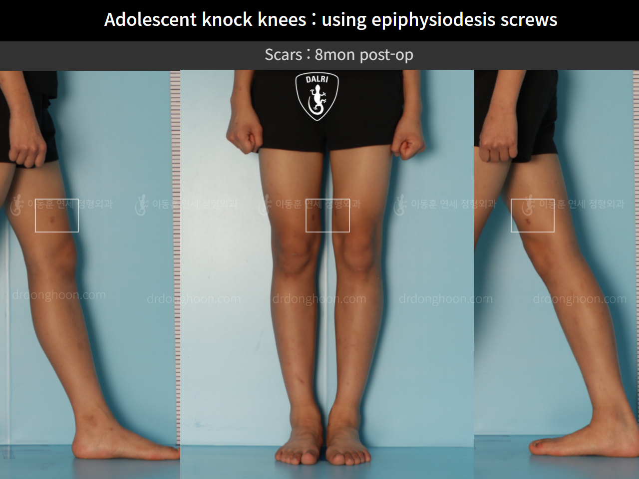 Before and after paediatric & adolescent knock knees, case 10171145, image 7, Dr. Donghoon institute (DALRI)