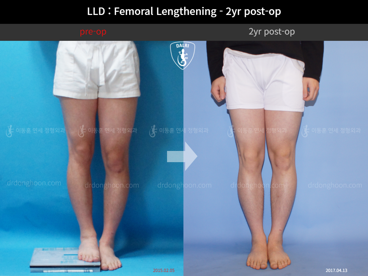 Before and after adult lld, case 4320322, image 3, Dr. Donghoon institute (DALRI)