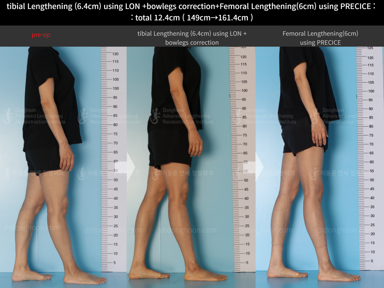 Before and after cll precice, case 13696246, image 3, Dr. Donghoon institute (DALRI)
