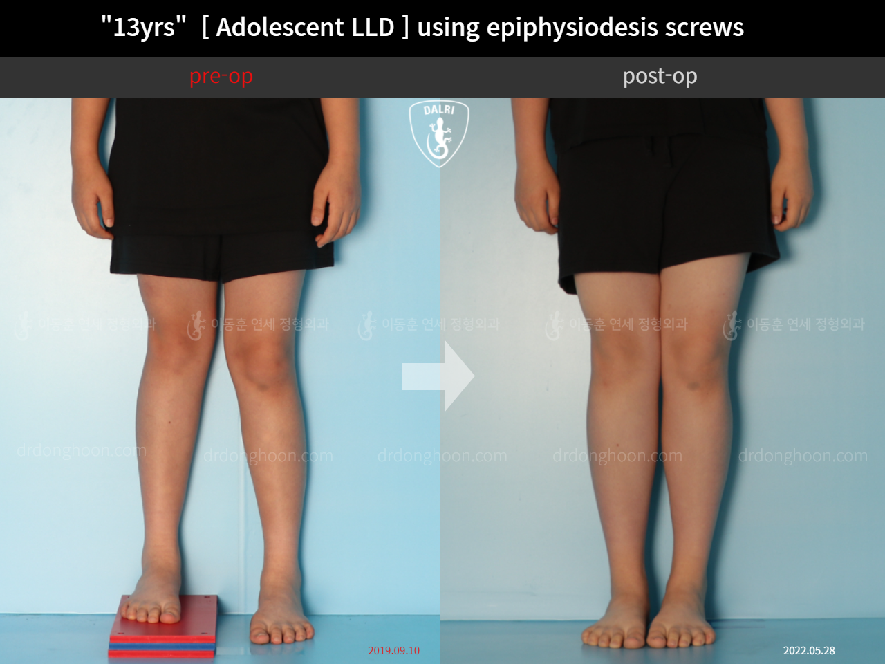 Before and after paediatric & adolescent lld, case 11773378, image 4, Dr. Donghoon institute (DALRI)