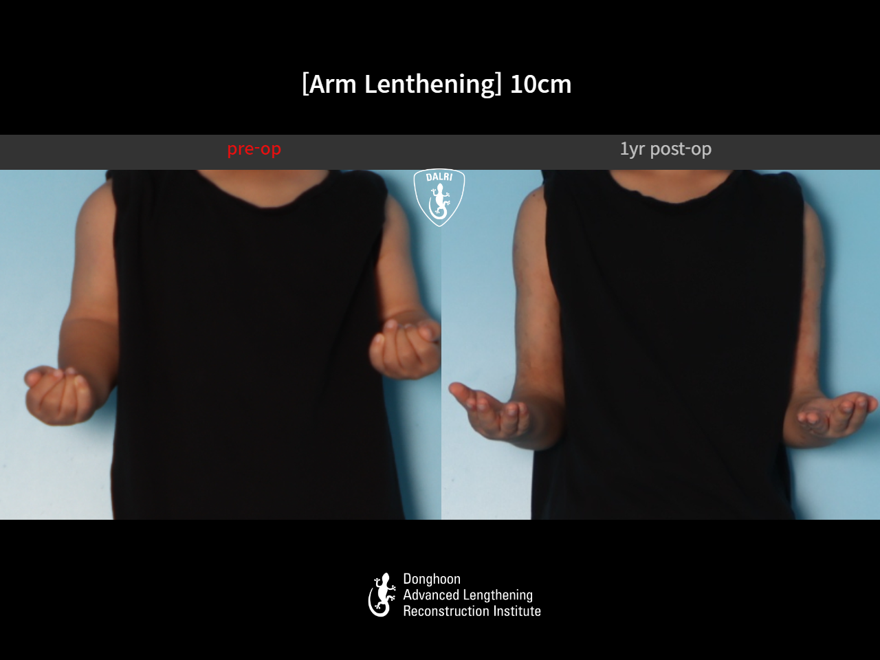 Before and after arm lengthening, case 31284248, image 4, Dr. Donghoon institute (DALRI)