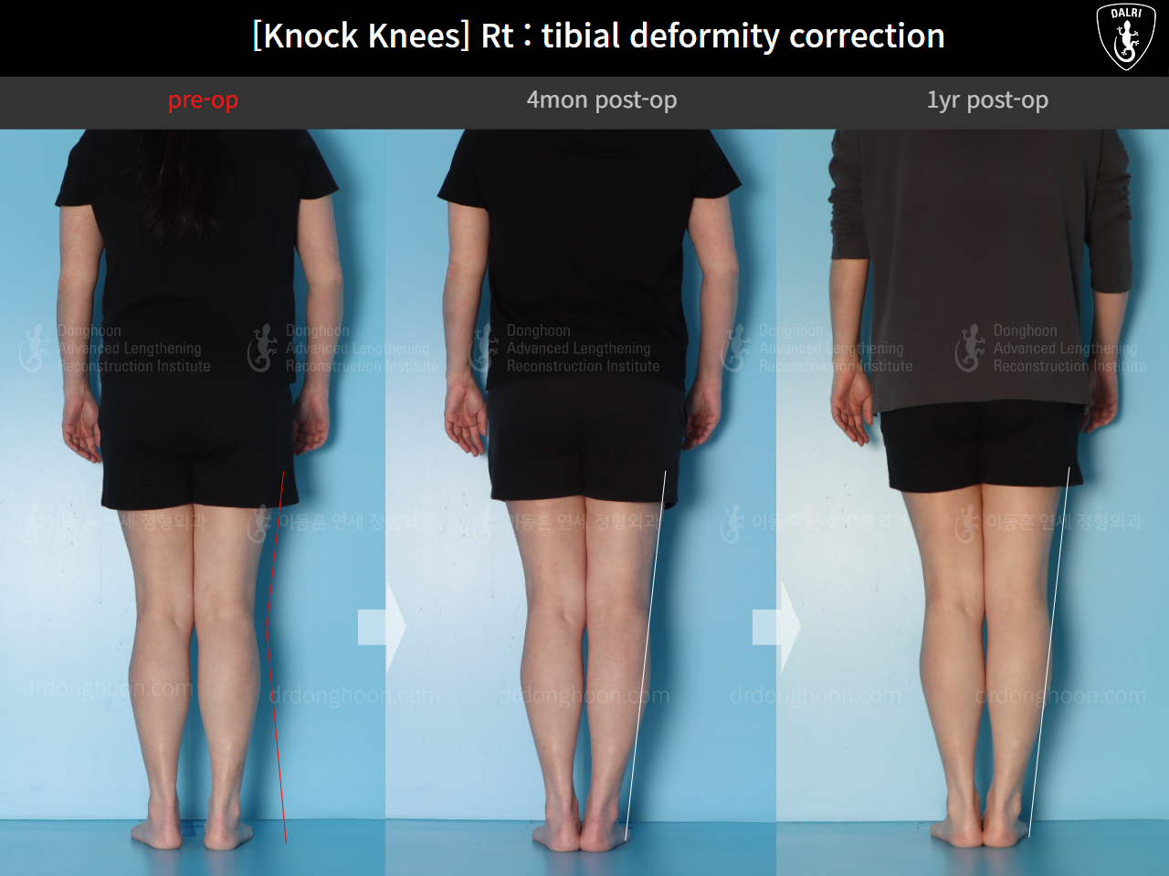 Before and after adult knock knees, case 18411627, image 4, Dr. Donghoon institute (DALRI)