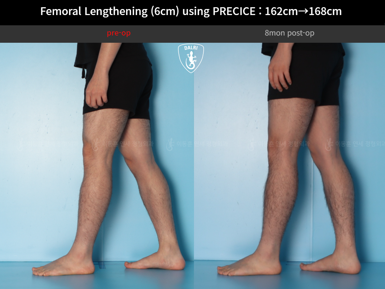 Before and after cll precice, case 52565195, image 9, Dr. Donghoon institute (DALRI)