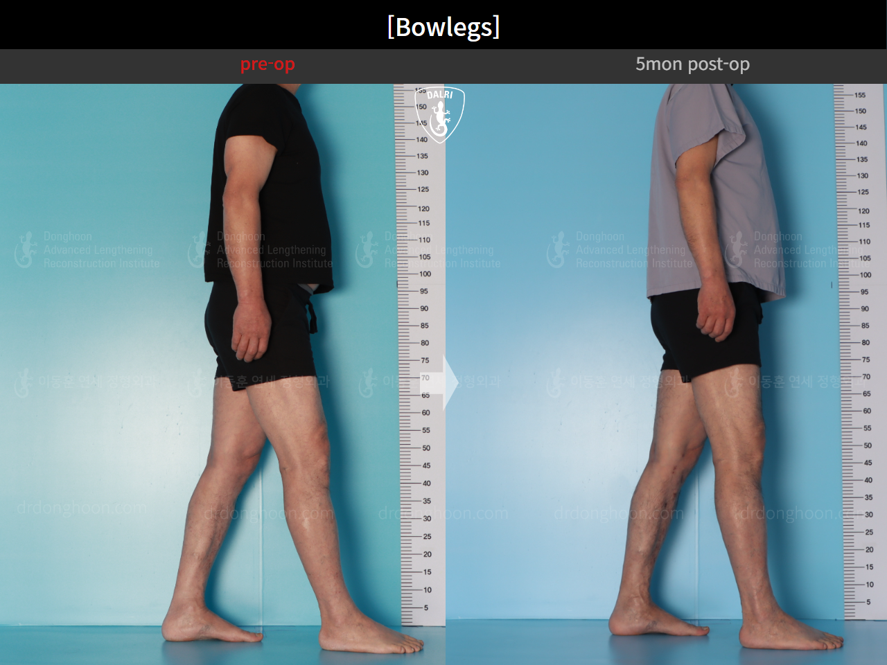 Before and after adult bowlegs, case 24988060, image 4, Dr. Donghoon institute (DALRI)