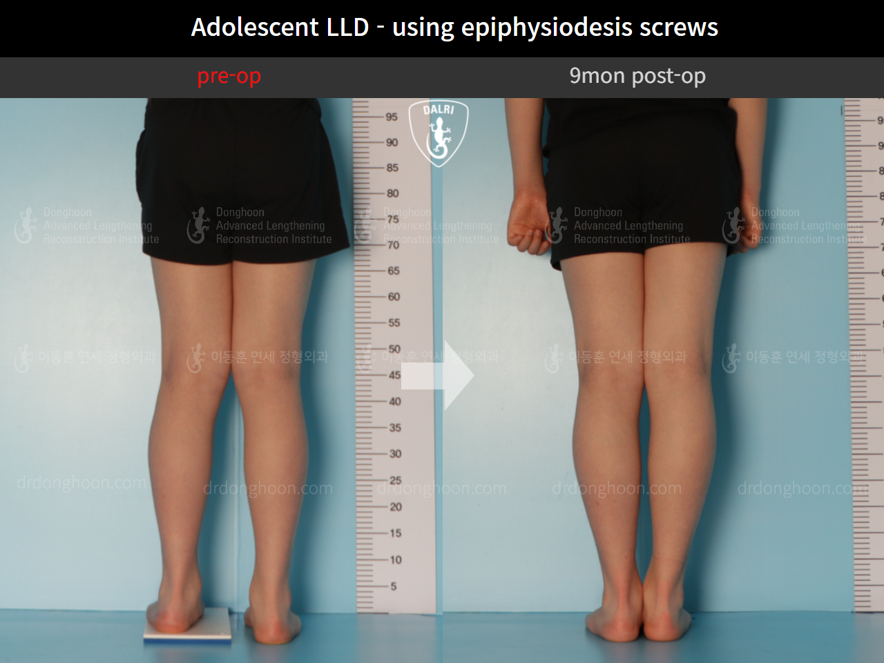 Before and after paediatric & adolescent lld, case 9572577, image 3, Dr. Donghoon institute (DALRI)