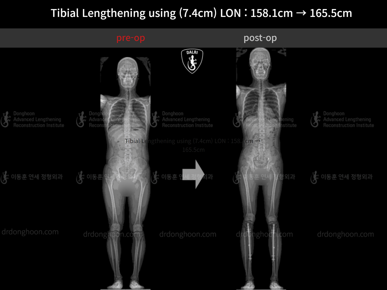 Before and after cll lon, case 12985247, image 1, Dr. Donghoon institute (DALRI)