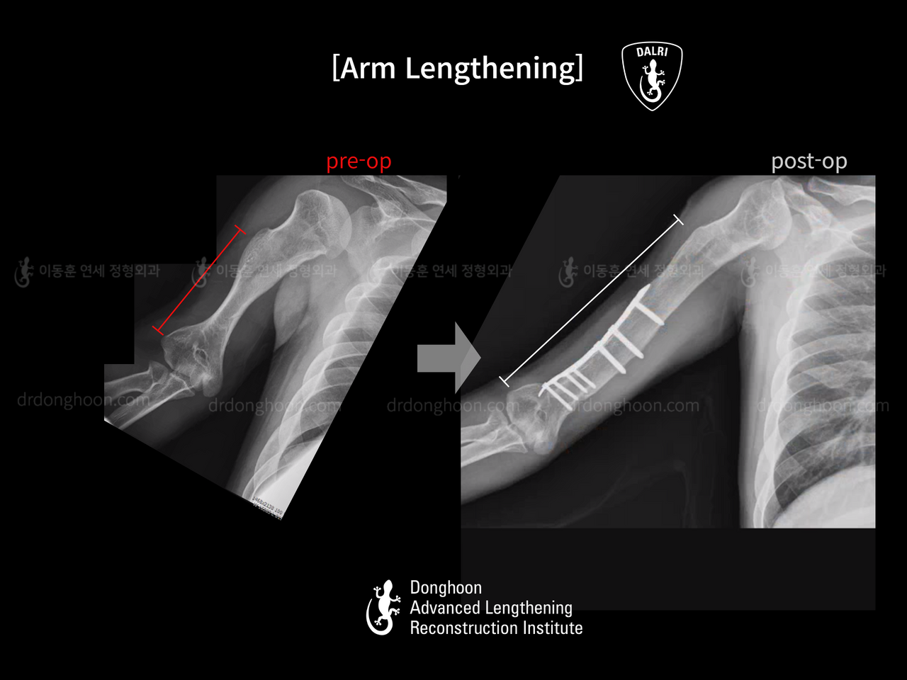 Before and after arm lengthening, case 13957846, image 4, Dr. Donghoon institute (DALRI)