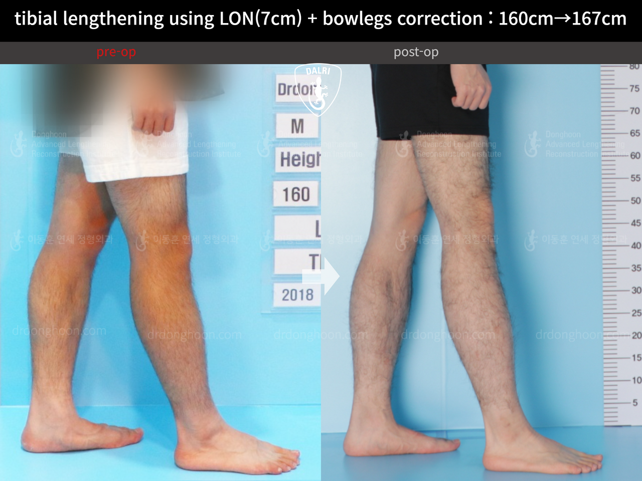 Before and after cll + deformity correction, case 13241722, image 8, Dr. Donghoon institute (DALRI)