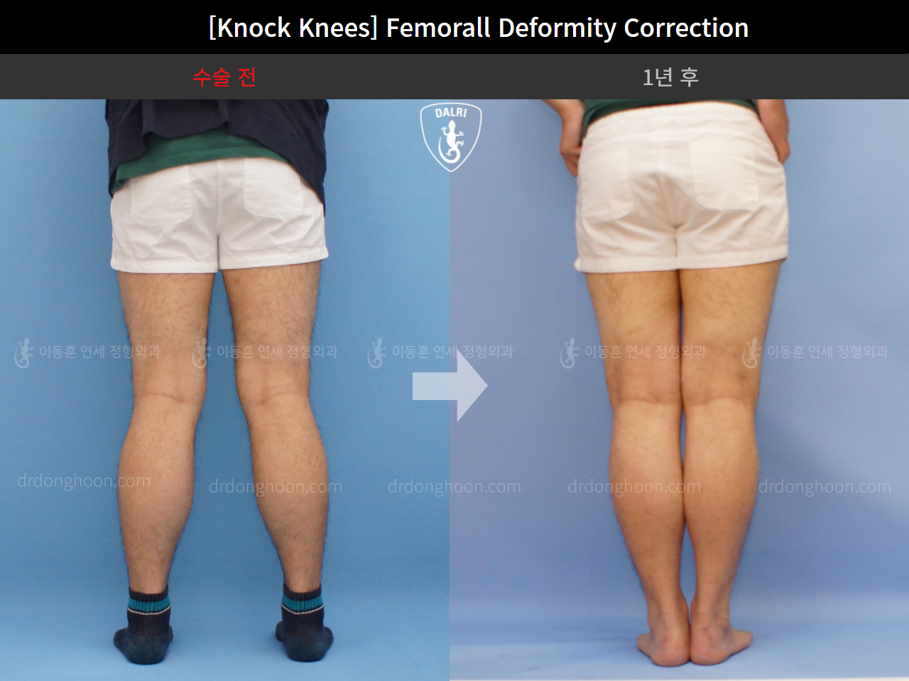 Before and after adult knock knees, case 4310847, image 4, Dr. Donghoon institute (DALRI)