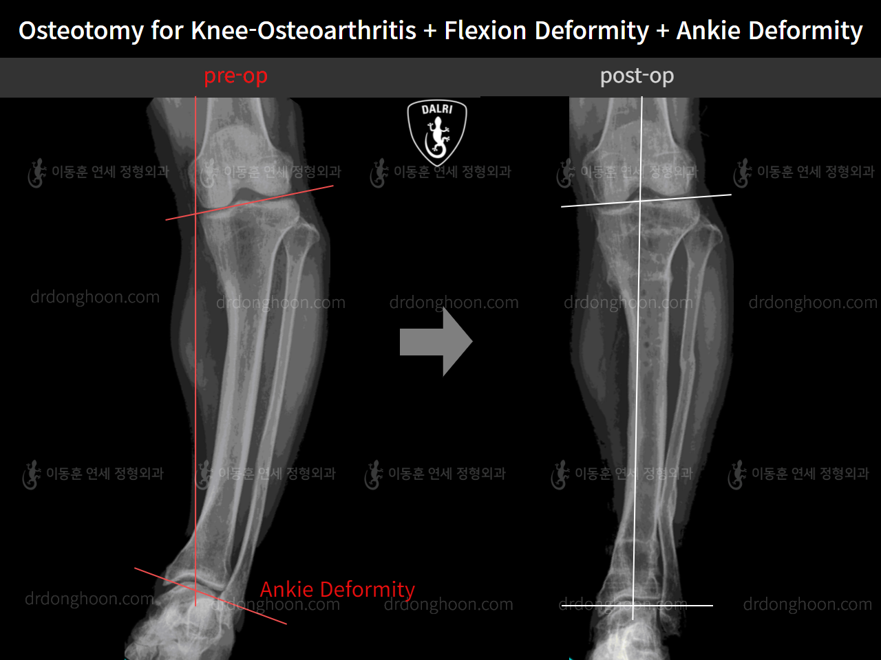 Before and after osteotomy for knee osteoarthritis, case 5315780, image 3, Dr. Donghoon institute (DALRI)