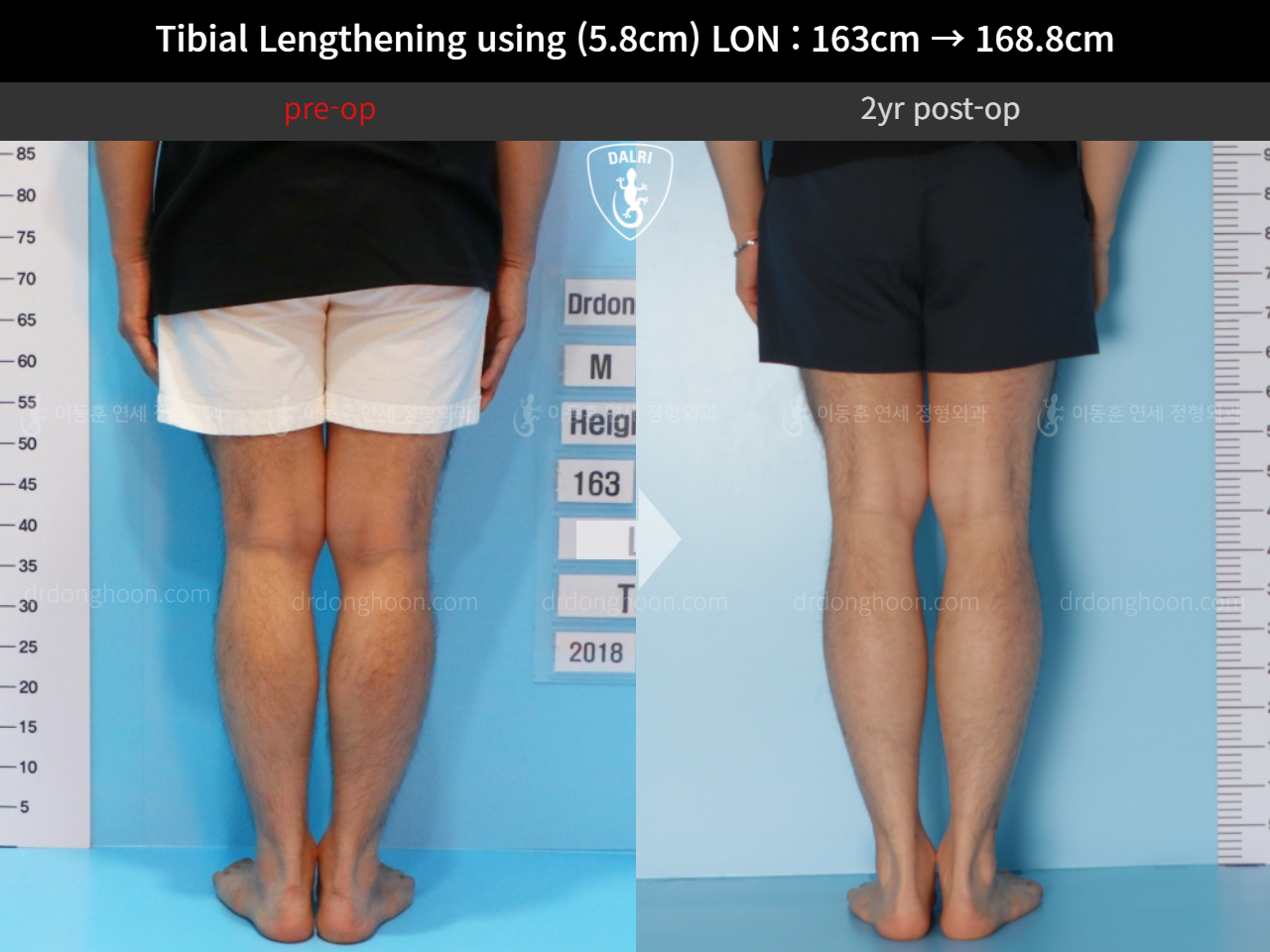 Before and after cll lon, case 11468172, image 6, Dr. Donghoon institute (DALRI)