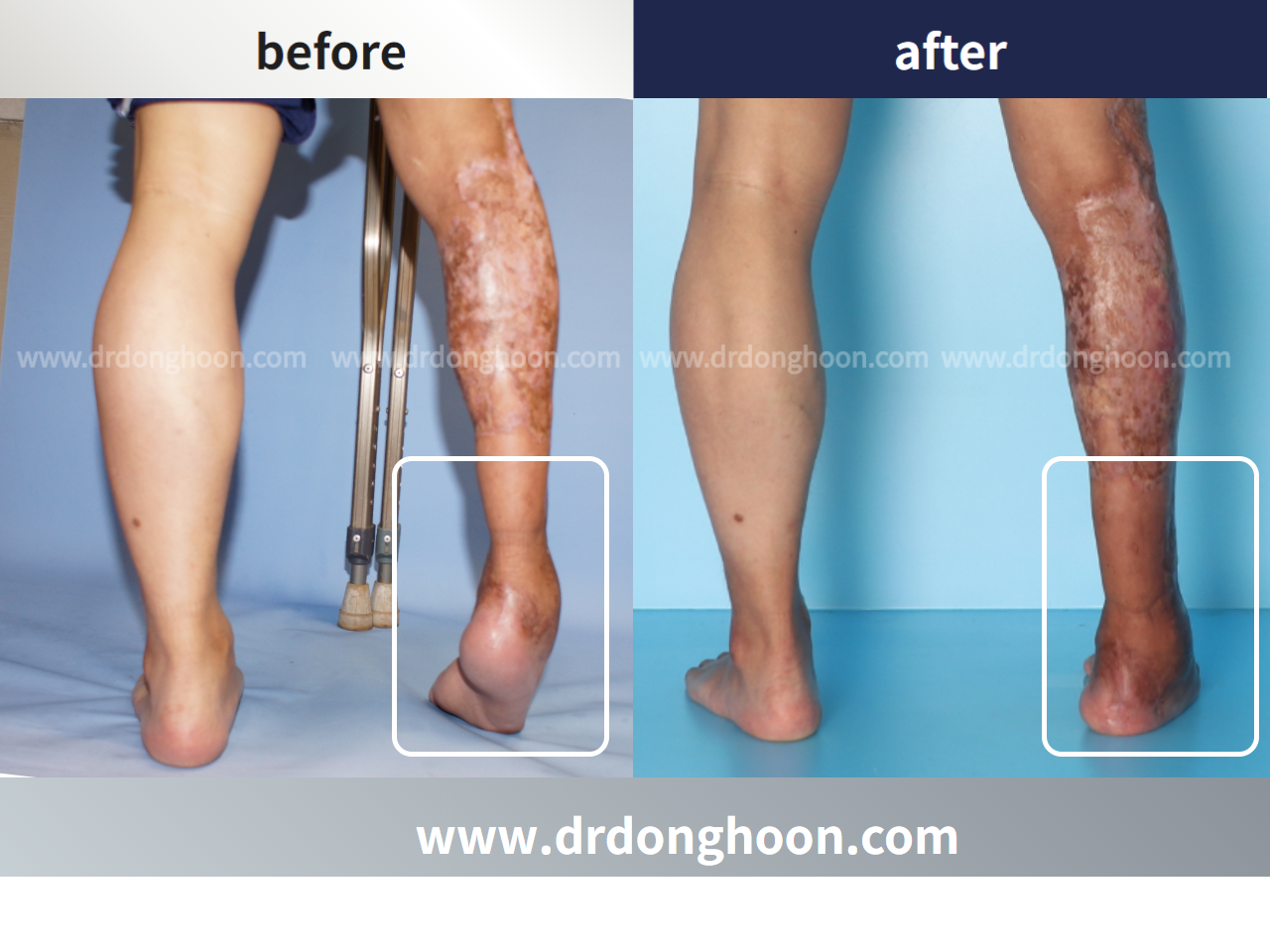 Before and after foot & ankle deformity, case 4248173, image 3, Dr. Donghoon institute (DALRI)