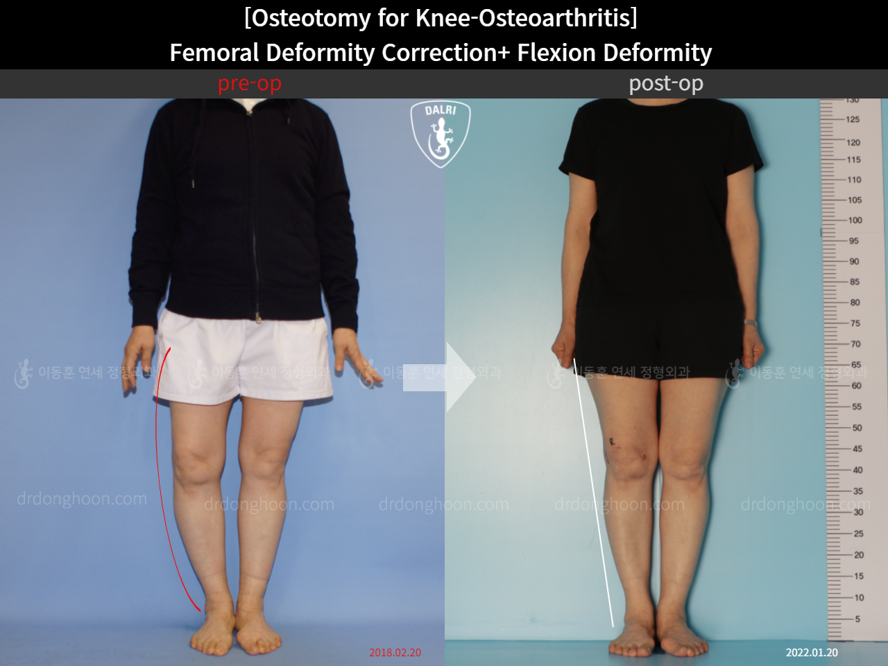 Before and after osteotomy for knee osteoarthritis, case 11380349, image 5, Dr. Donghoon institute (DALRI)
