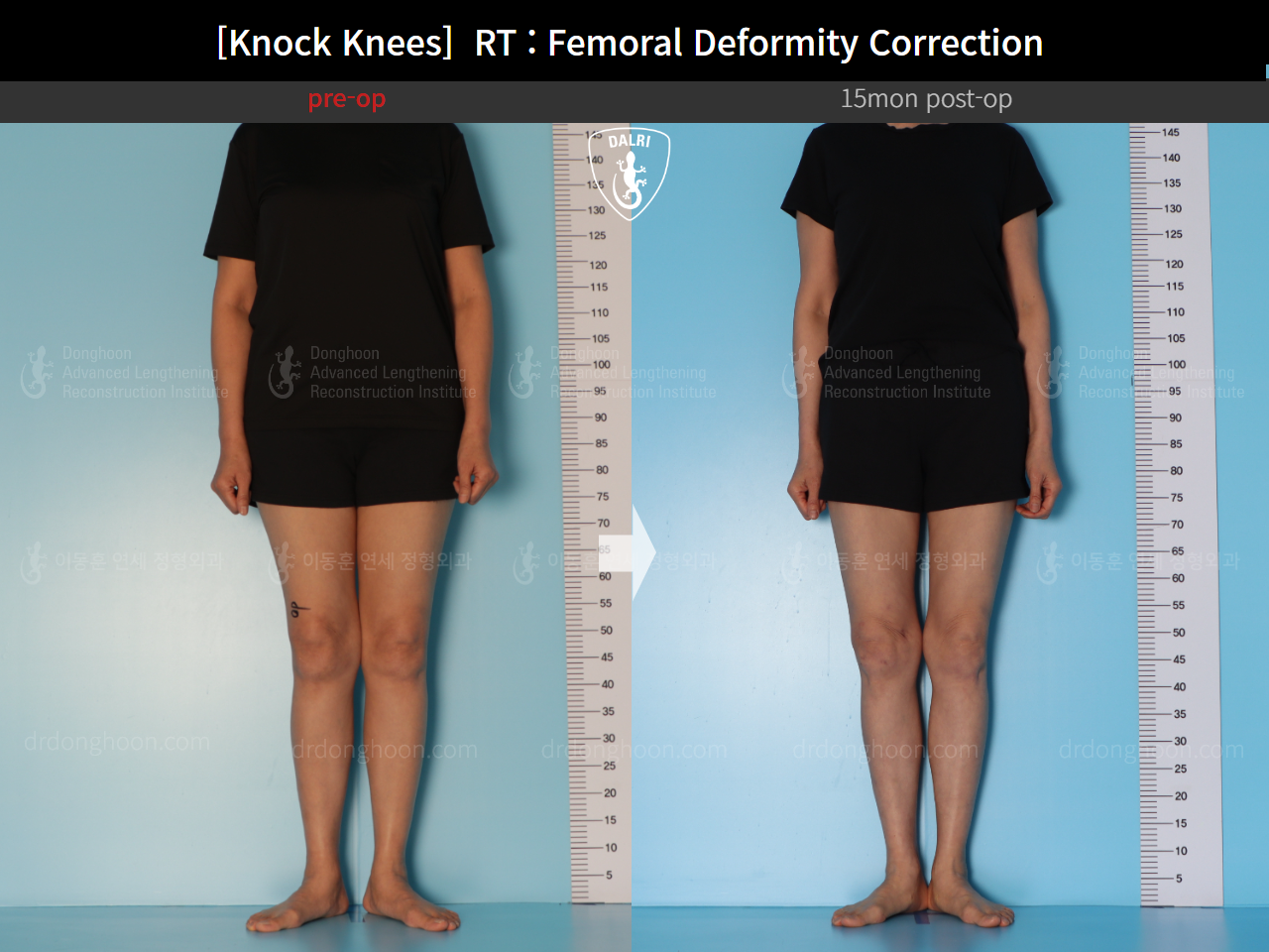 Before and after adult knock knees, case 14462642, image 4, Dr. Donghoon institute (DALRI)