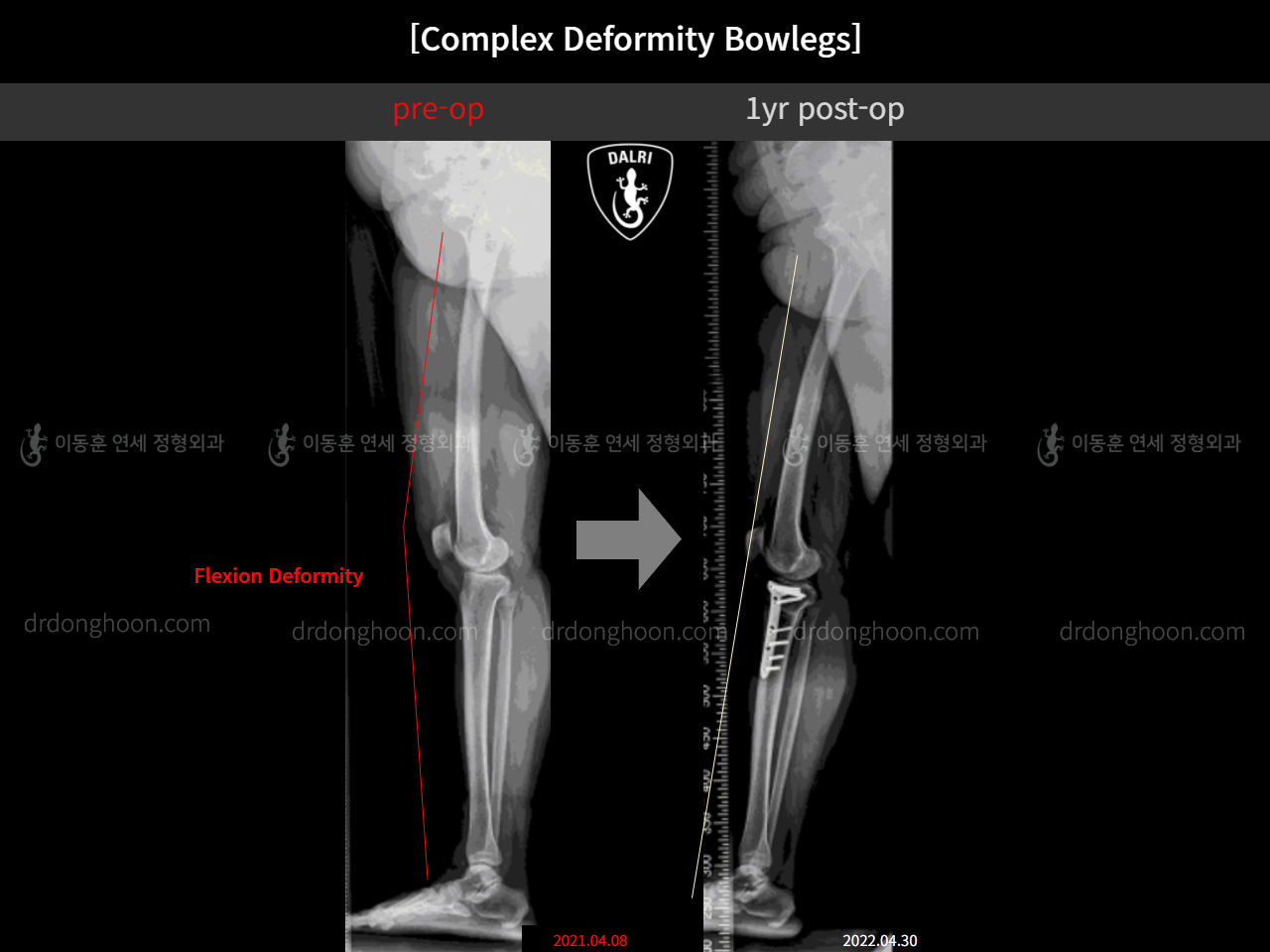 Before and after adult bowlegs, case 11339611, image 10, Dr. Donghoon institute (DALRI)