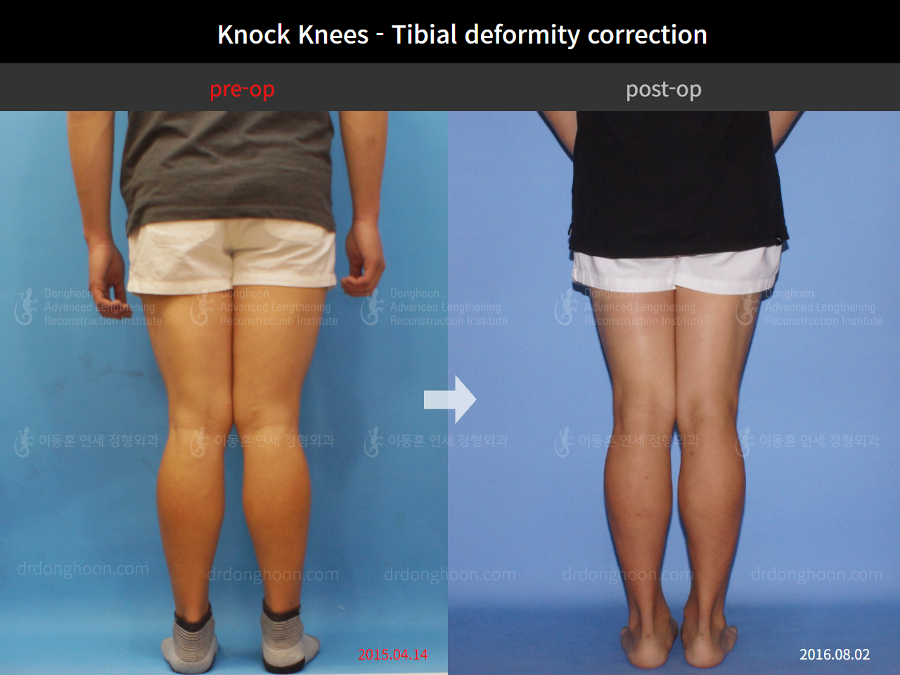 Before and after adult knock knees, case 4310817, image 2, Dr. Donghoon institute (DALRI)