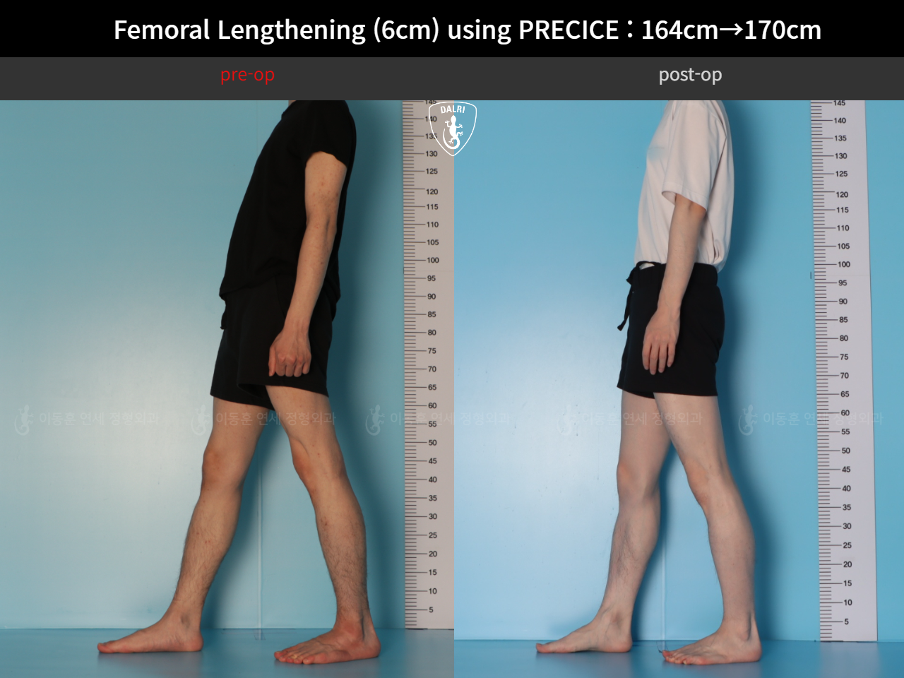 Before and after cll precice, case 33570290, image 6, Dr. Donghoon institute (DALRI)