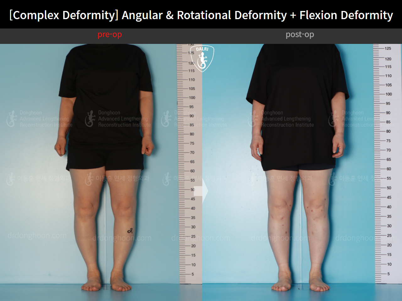 Before and after adult bowlegs, case 16781344, image 2, Dr. Donghoon institute (DALRI)