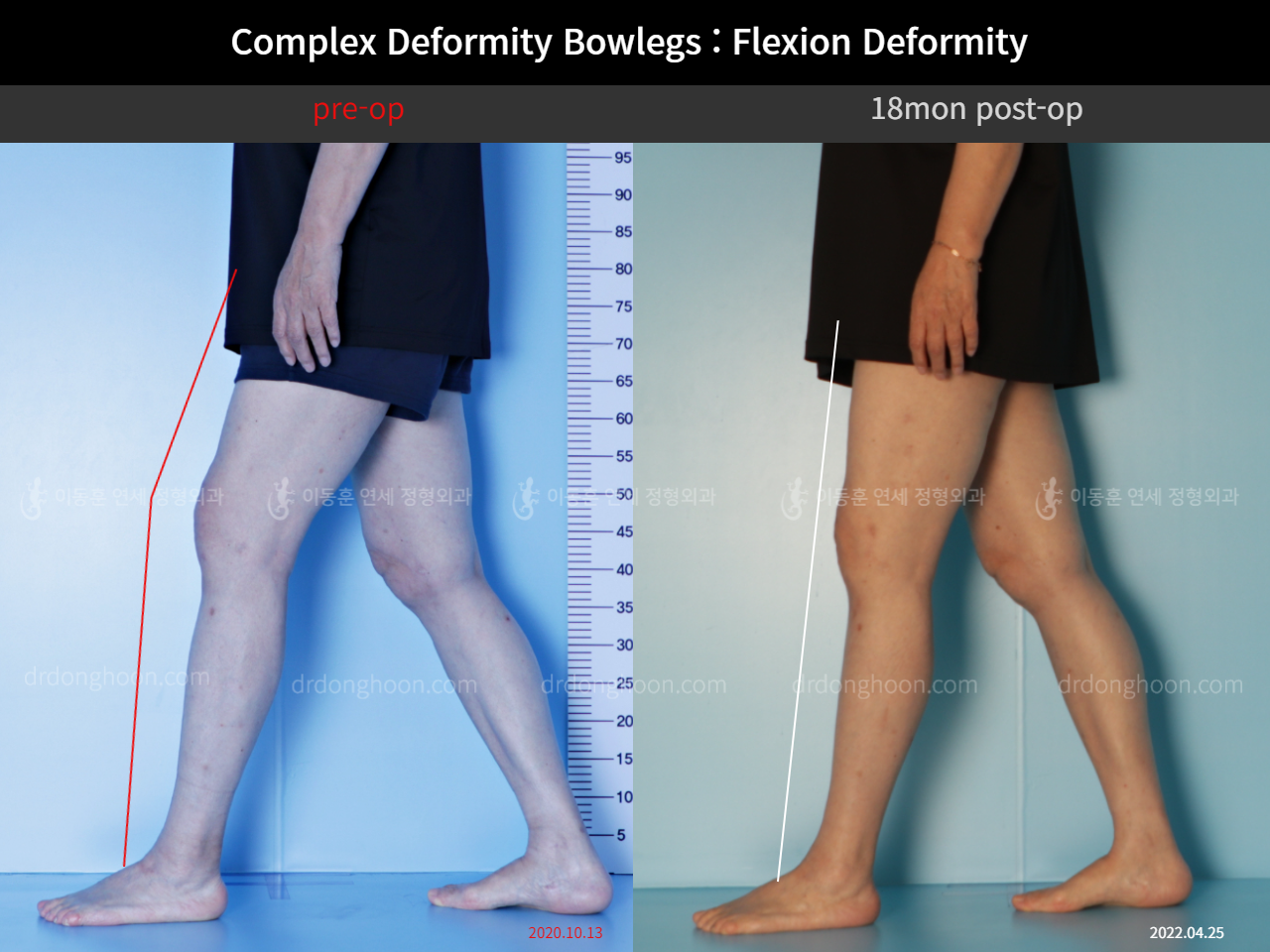Before and after osteotomy for knee osteoarthritis, case 11337460, image 13, Dr. Donghoon institute (DALRI)