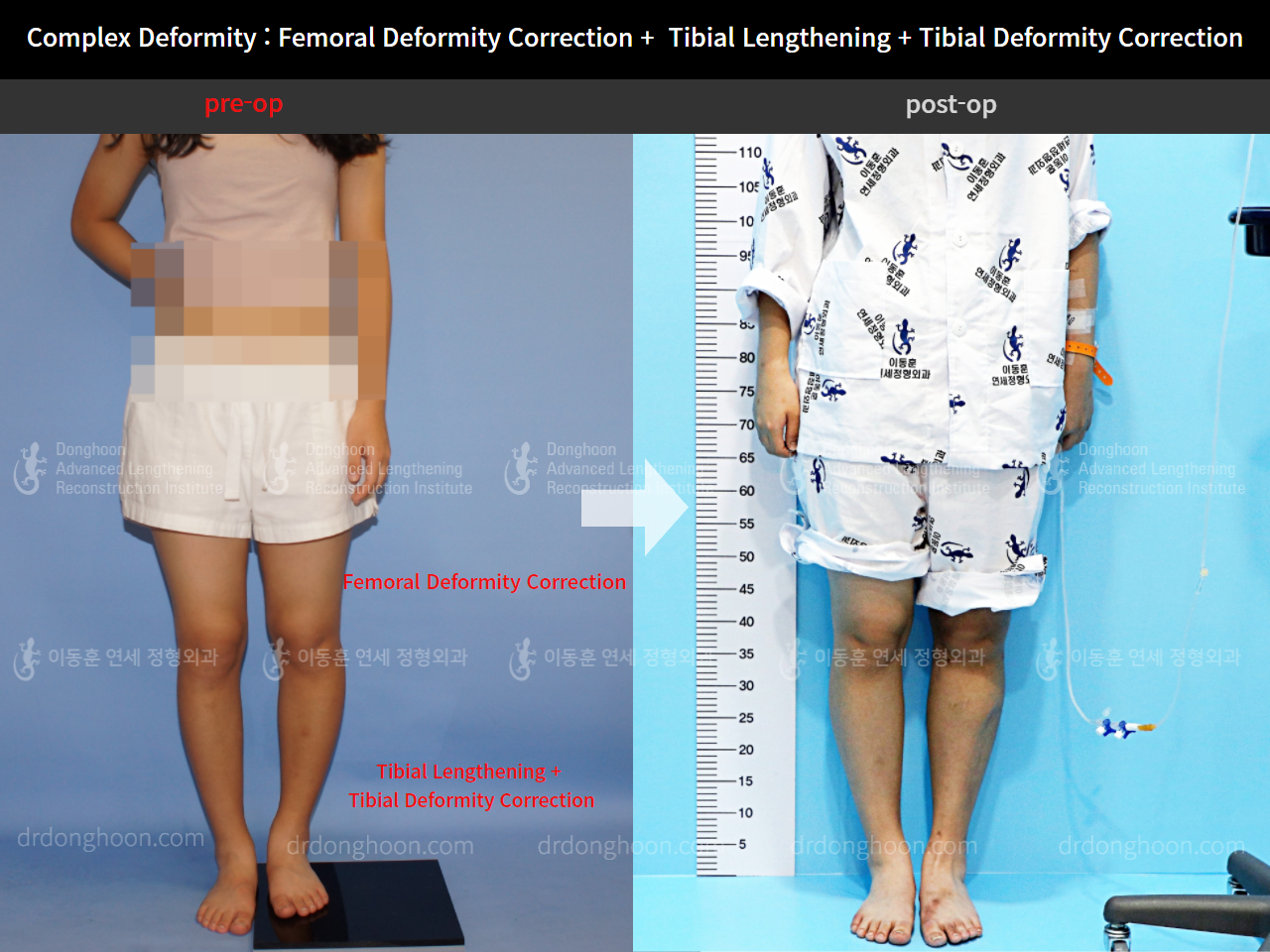 Before and after adult lld, case 4320351, image 2, Dr. Donghoon institute (DALRI)