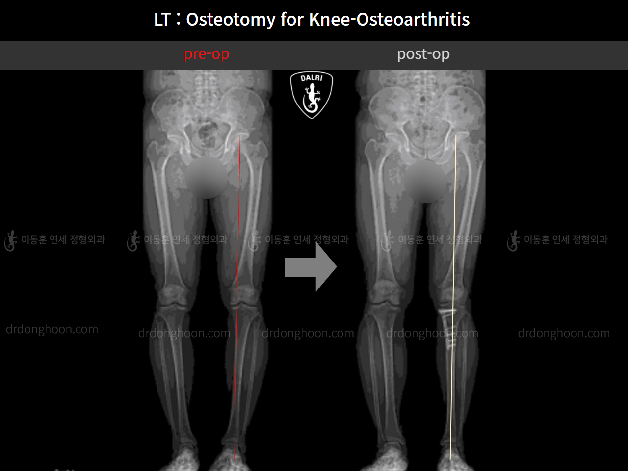 Before and after osteotomy for knee osteoarthritis, case 11065448, image 6, Dr. Donghoon institute (DALRI)