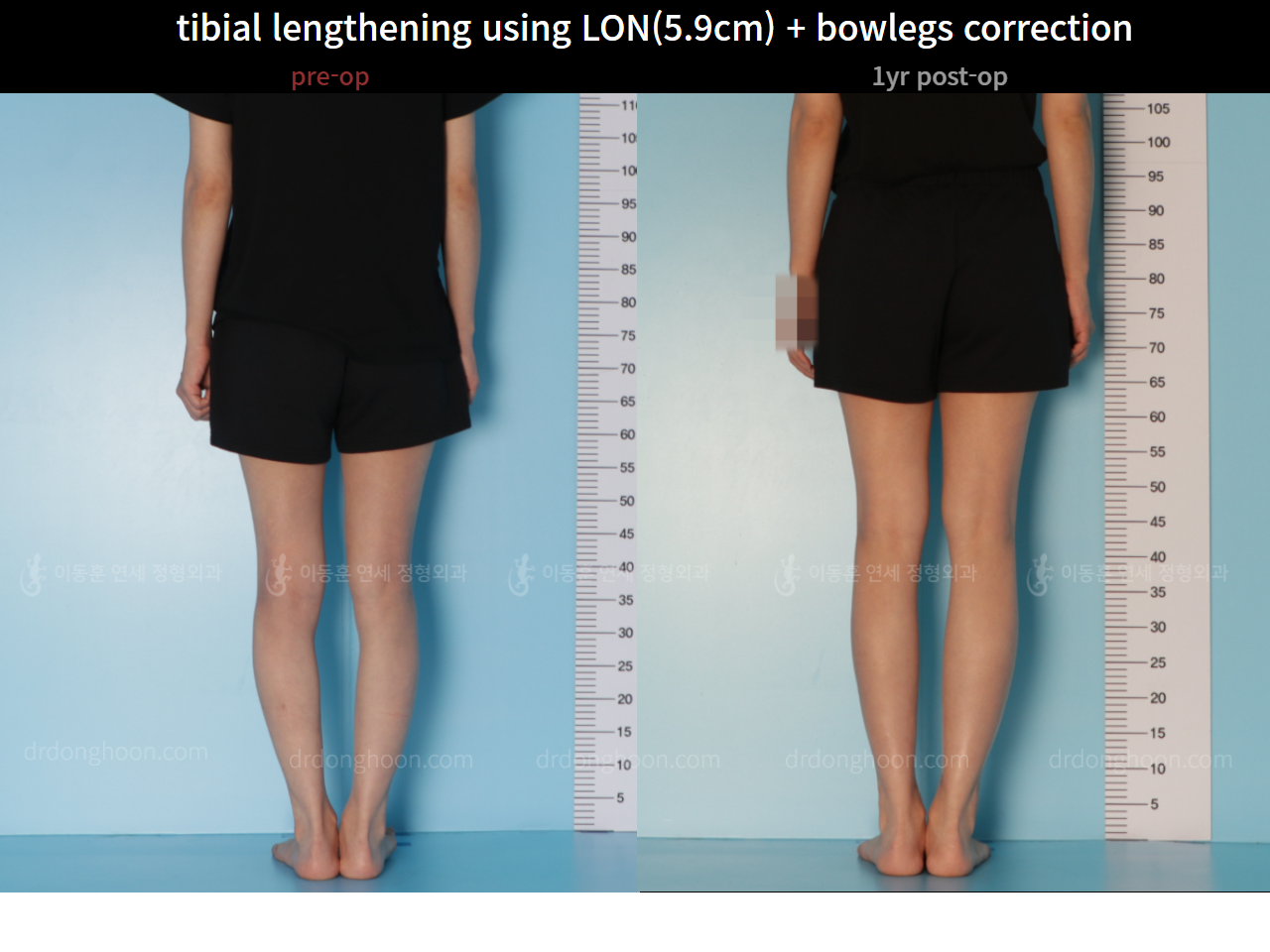 Tibial Lengthening Using LON(5.9cm) + Bowlegs Correction : CLL ...