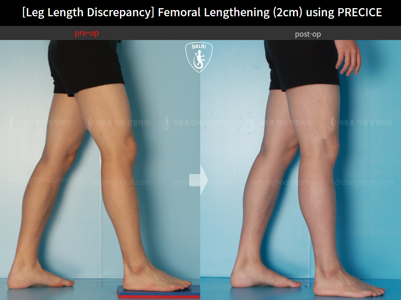 Before and after adult lld, case 16061128, image 8, Dr. Donghoon institute (DALRI)