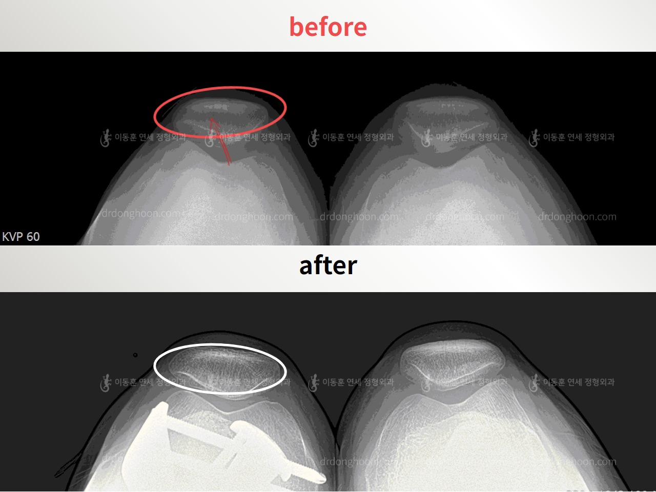 Before and after recurrent patella dislocation, case 4594075, image 1, Dr. Donghoon institute (DALRI)