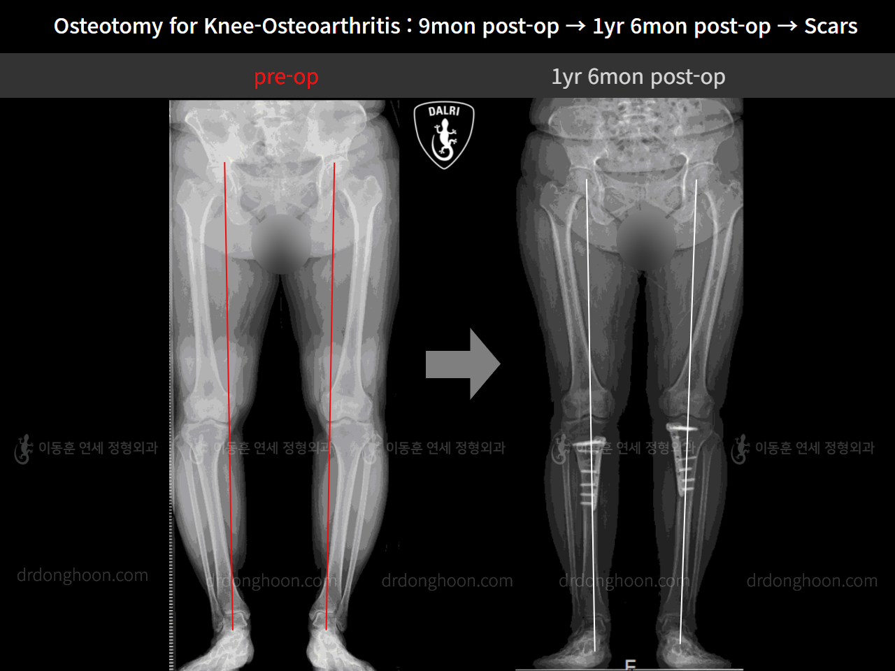 Before and after osteotomy for knee osteoarthritis, case 11203744, image 7, Dr. Donghoon institute (DALRI)