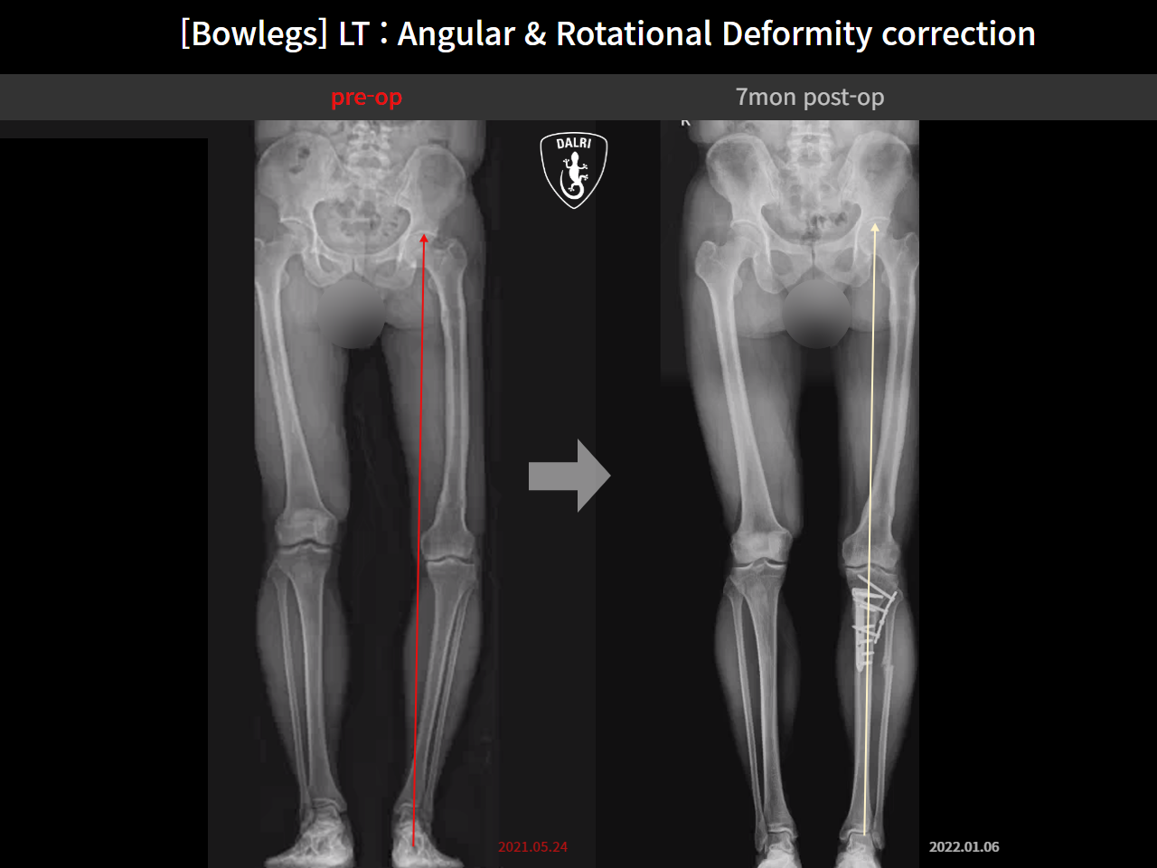 Before and after adult bowlegs, case 14502452, image 3, Dr. Donghoon institute (DALRI)