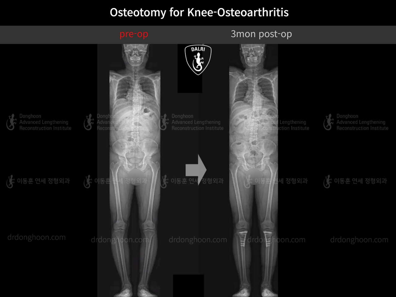 Before and after osteotomy for knee osteoarthritis, case 13696339, image 3, Dr. Donghoon institute (DALRI)