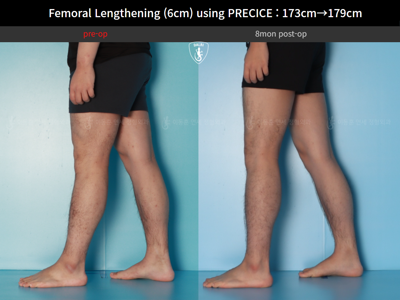 Before and after cll precice, case 89066969, image 10, Dr. Donghoon institute (DALRI)