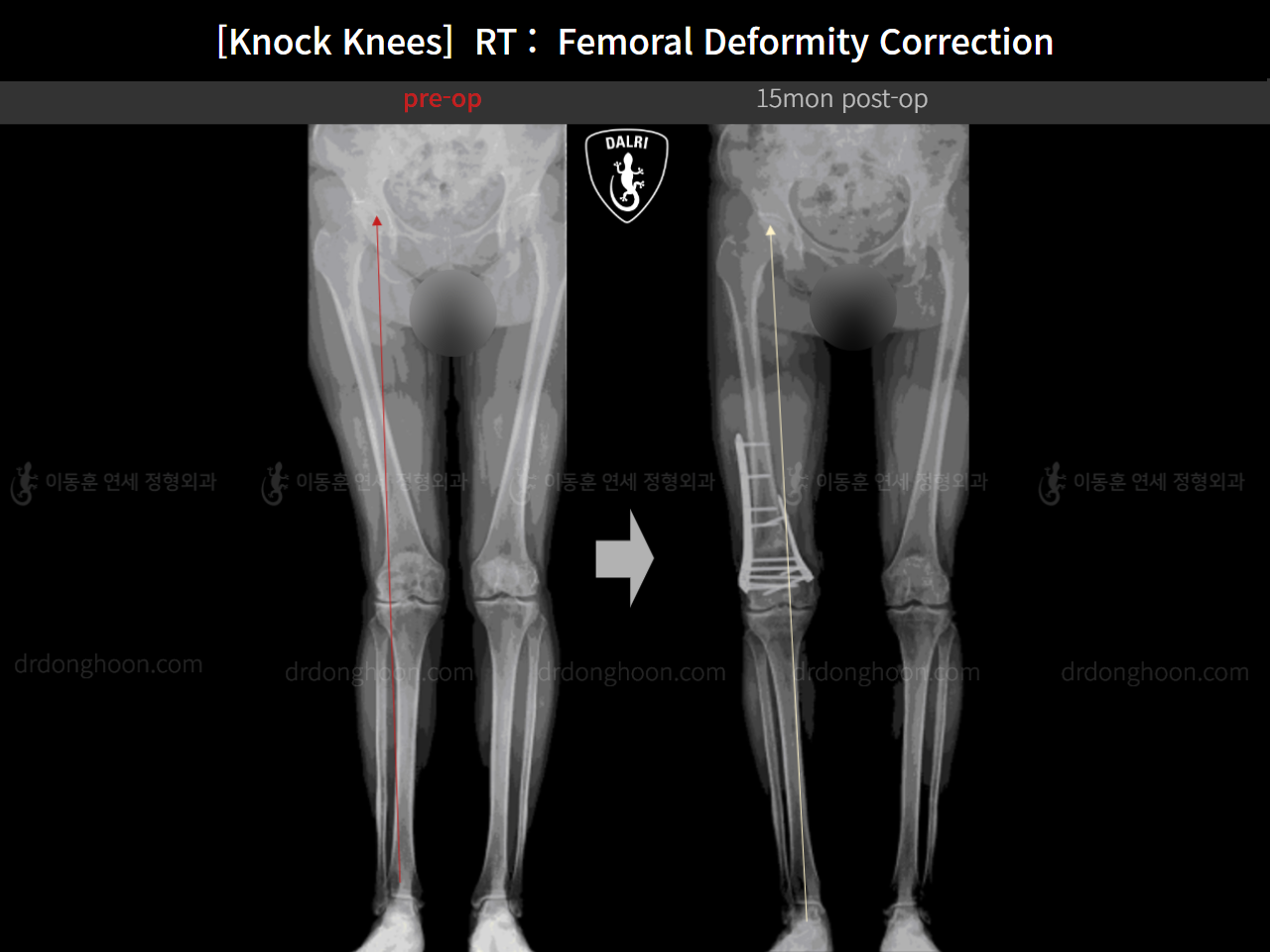 Before and after adult knock knees, case 14462642, image 10, Dr. Donghoon institute (DALRI)