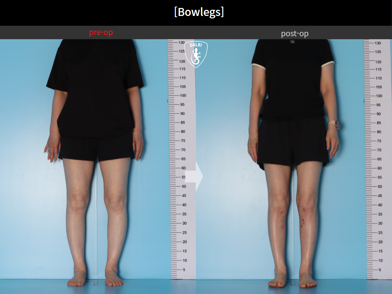 Before and after adult bowlegs, case 30256399, image 3, Dr. Donghoon institute (DALRI)