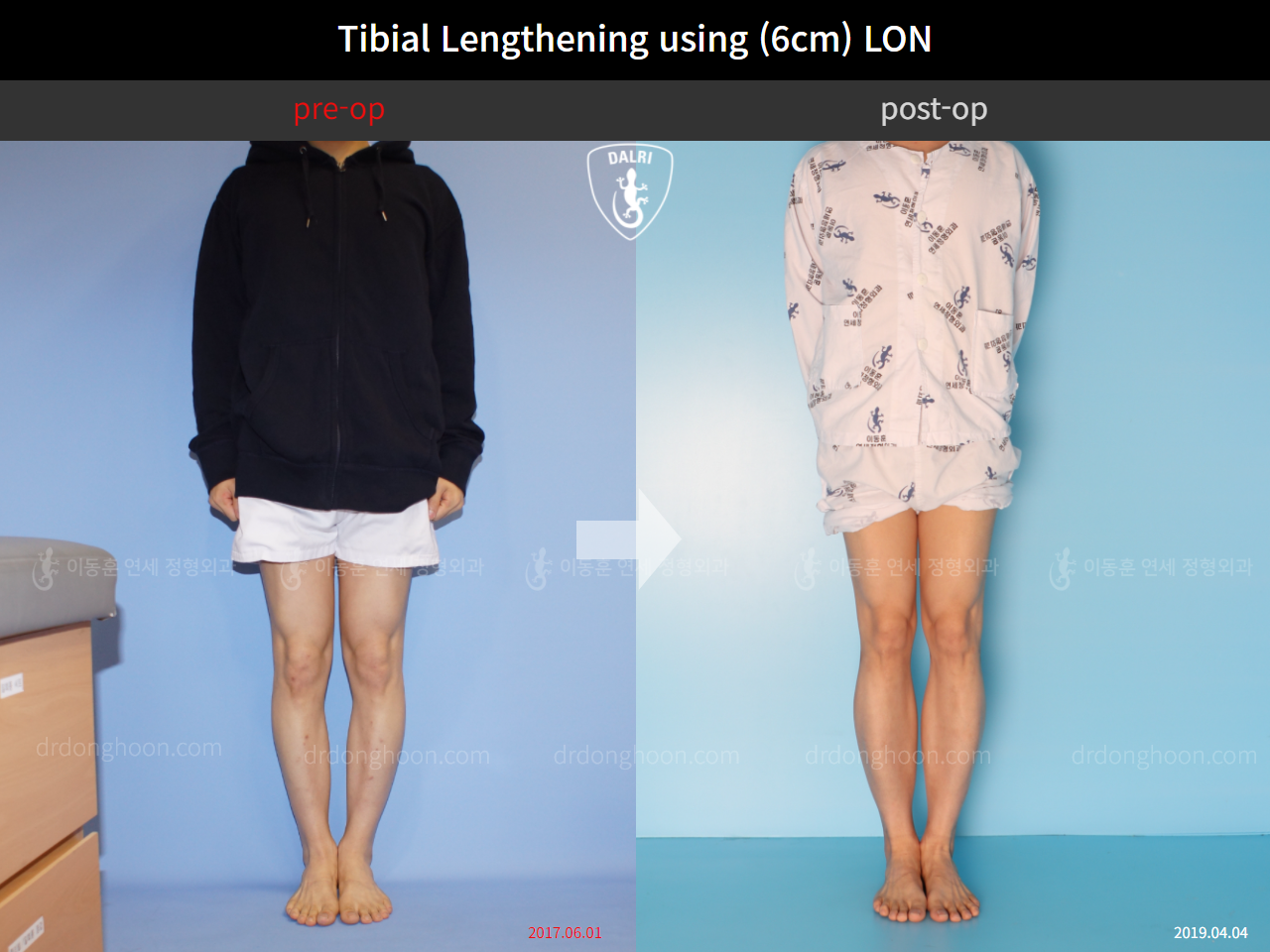 Before and after cll lon, case 4577694, image 1, Dr. Donghoon institute (DALRI)
