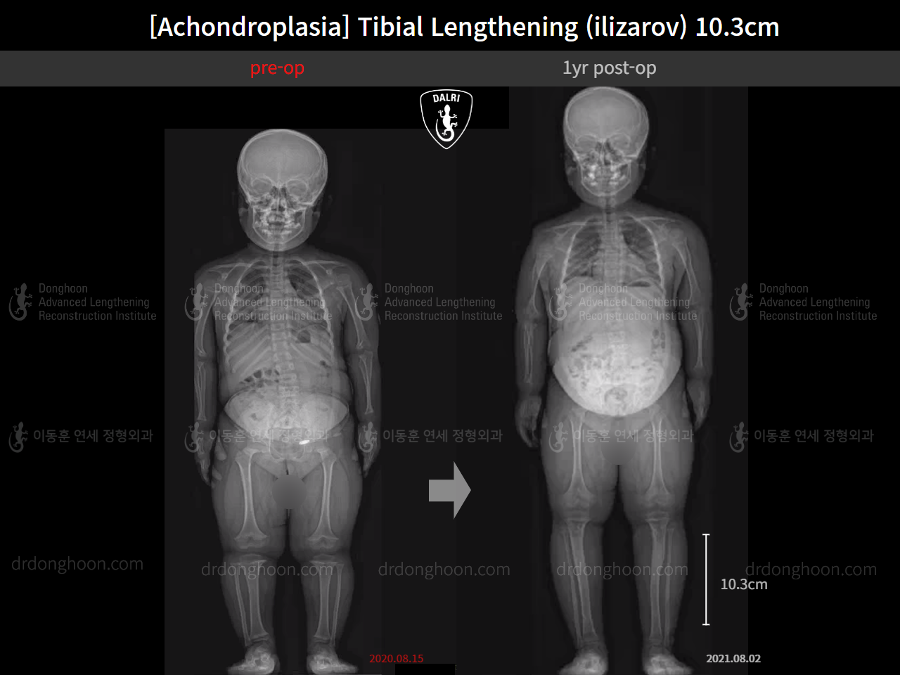 Before and after paediatric congenital condition, case 14507301, image 1, Dr. Donghoon institute (DALRI)
