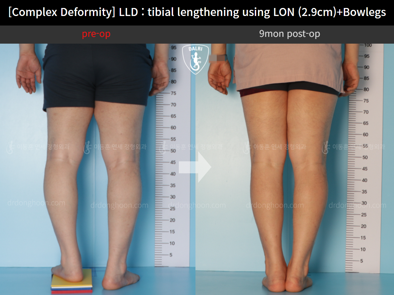 Before and after adult lld, case 11233977, image 5, Dr. Donghoon institute (DALRI)