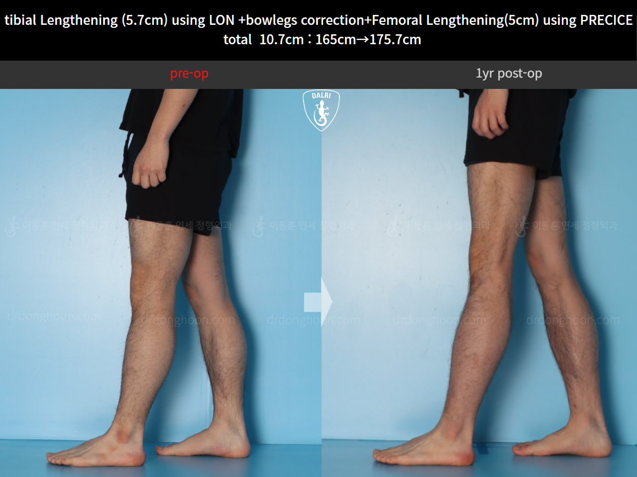 Before and after cll + deformity correction, case 20363398, image 9, Dr. Donghoon institute (DALRI)