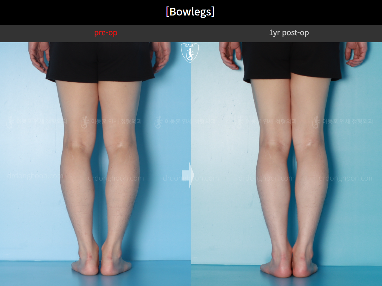 Before and after adult bowlegs, case 16724494, image 9, Dr. Donghoon institute (DALRI)