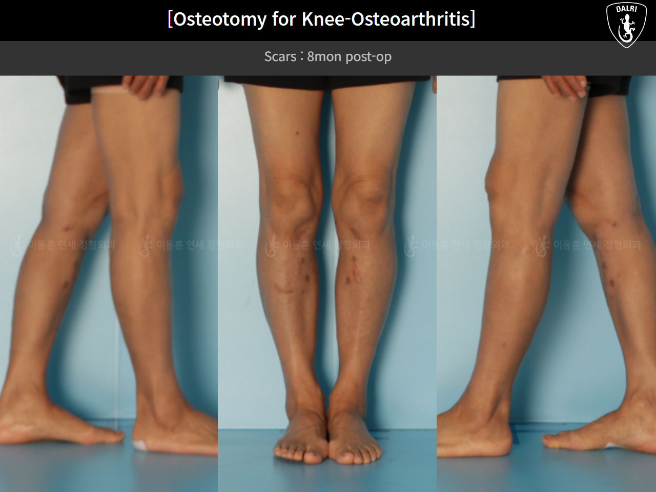 Before and after osteotomy for knee osteoarthritis, case 85842641, image 9, Dr. Donghoon institute (DALRI)