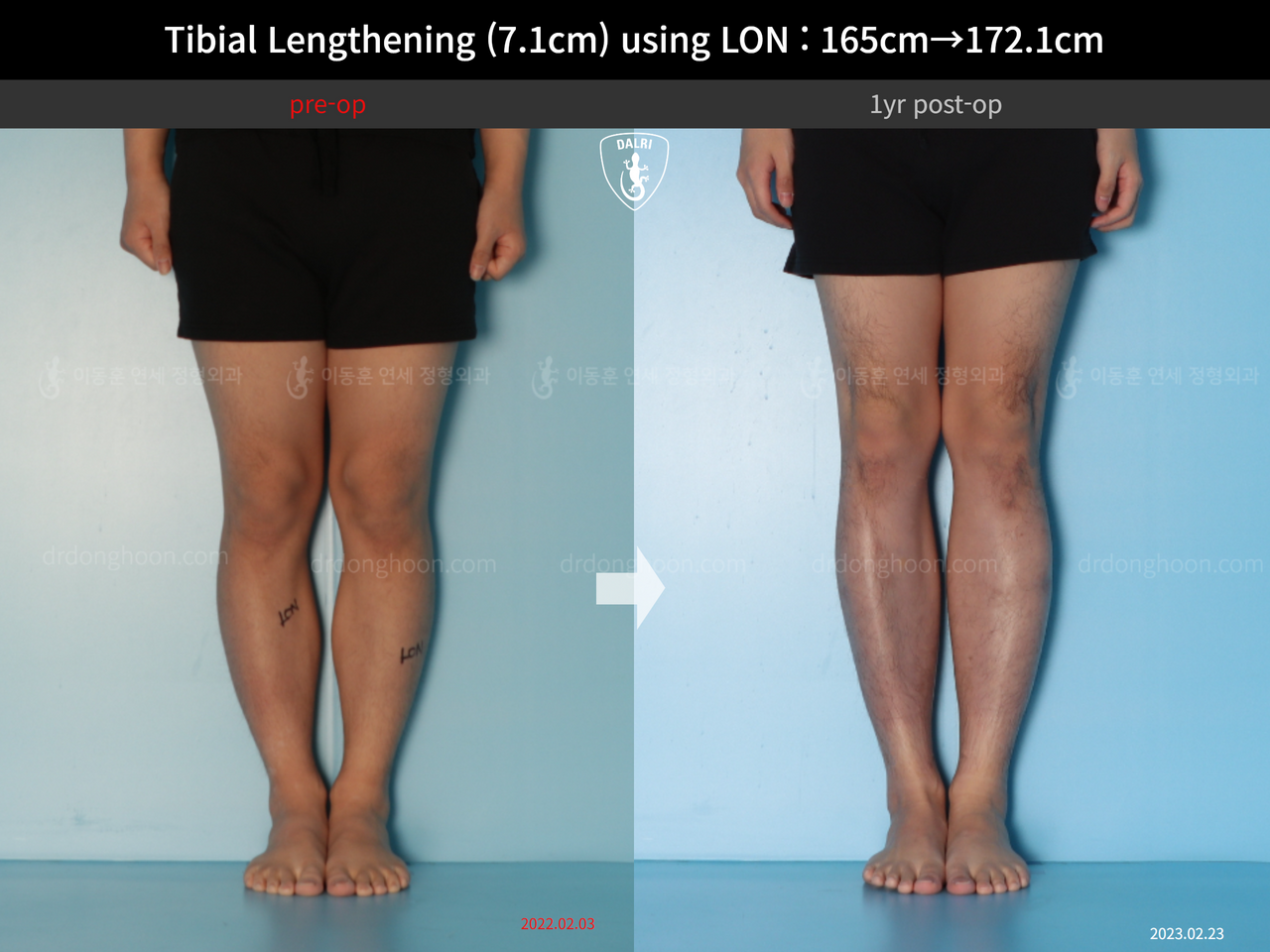 Before and after cll lon, case 14318674, image 7, Dr. Donghoon institute (DALRI)
