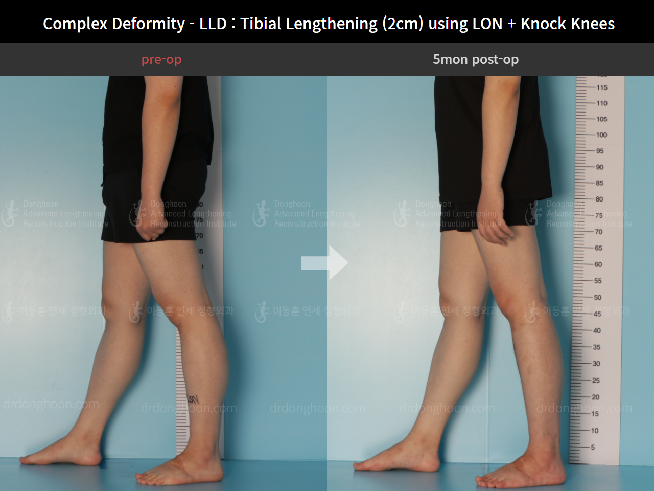 Before and after complex deformity, case 8394665, image 4, Dr. Donghoon institute (DALRI)