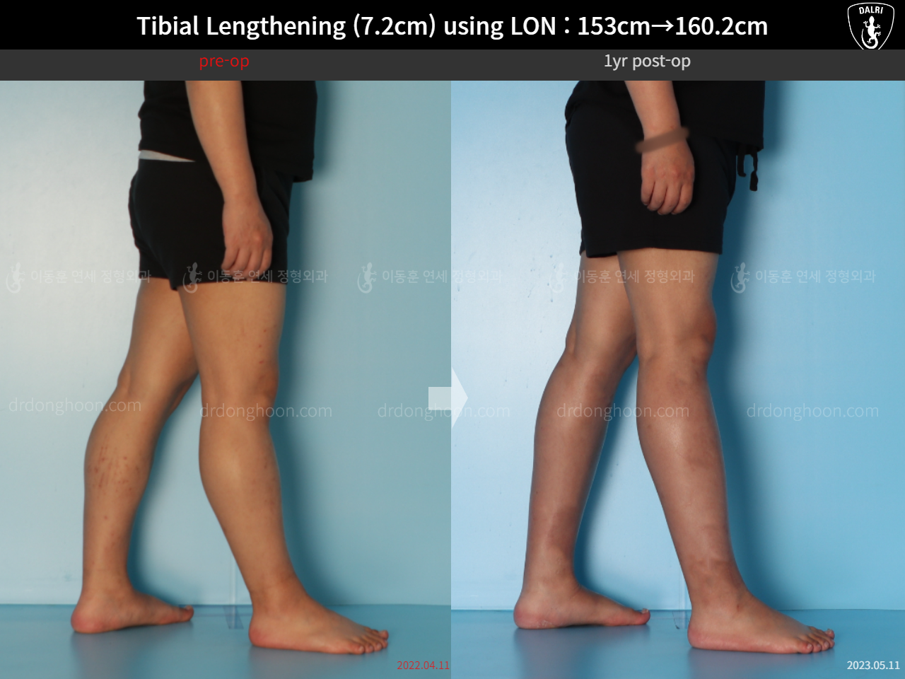 Before and after cll lon, case 15150707, image 8, Dr. Donghoon institute (DALRI)