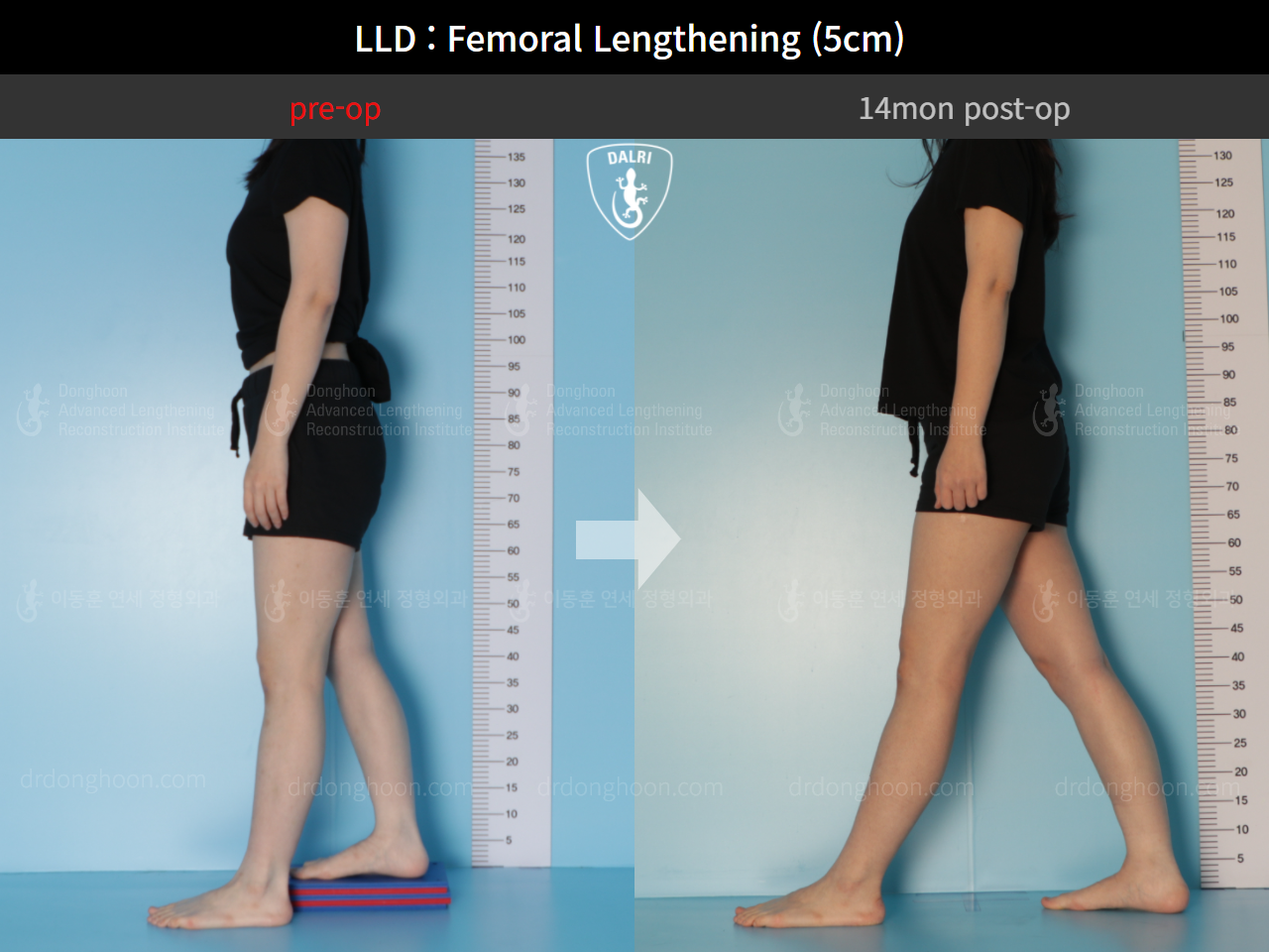 Before and after adult lld, case 9366304, image 4, Dr. Donghoon institute (DALRI)