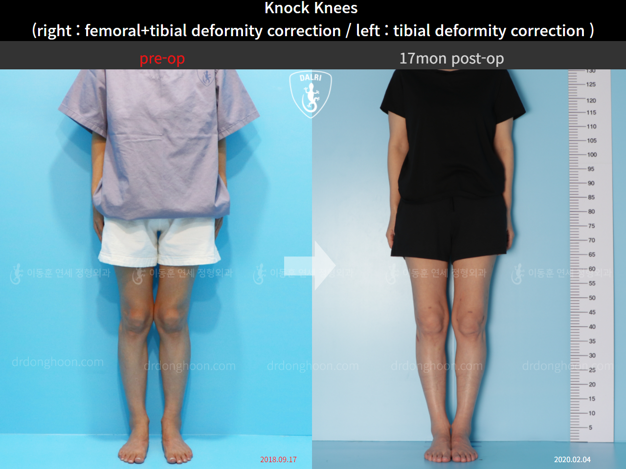 Before and after adult knock knees, case 4640565, image 1, Dr. Donghoon institute (DALRI)