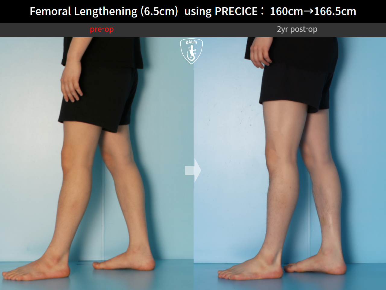 Before and after cll precice, case 27369651, image 10, Dr. Donghoon institute (DALRI)