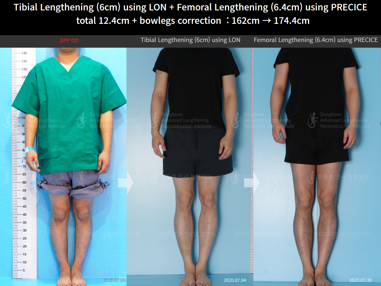 Before and after cll precice, case 14631295, image 1, Dr. Donghoon institute (DALRI)